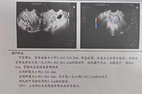 子宫肌瘤报告单